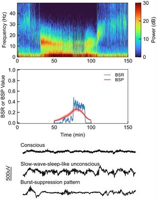 Etiology of Burst Suppression EEG Patterns